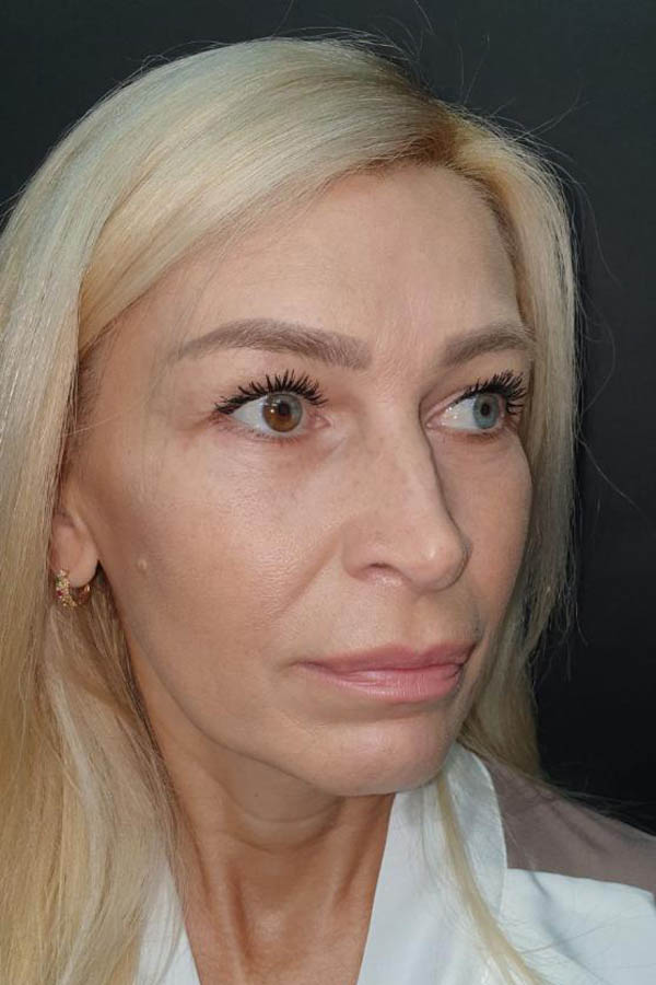 пластика повік жиром львів