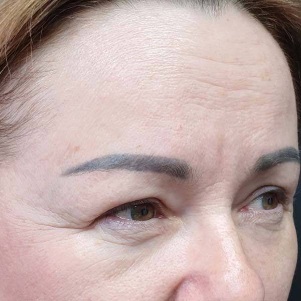 блефаропластика луцьк