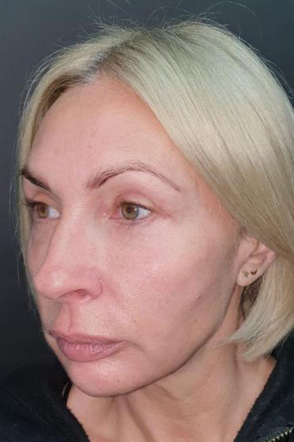 блефаропластика львів