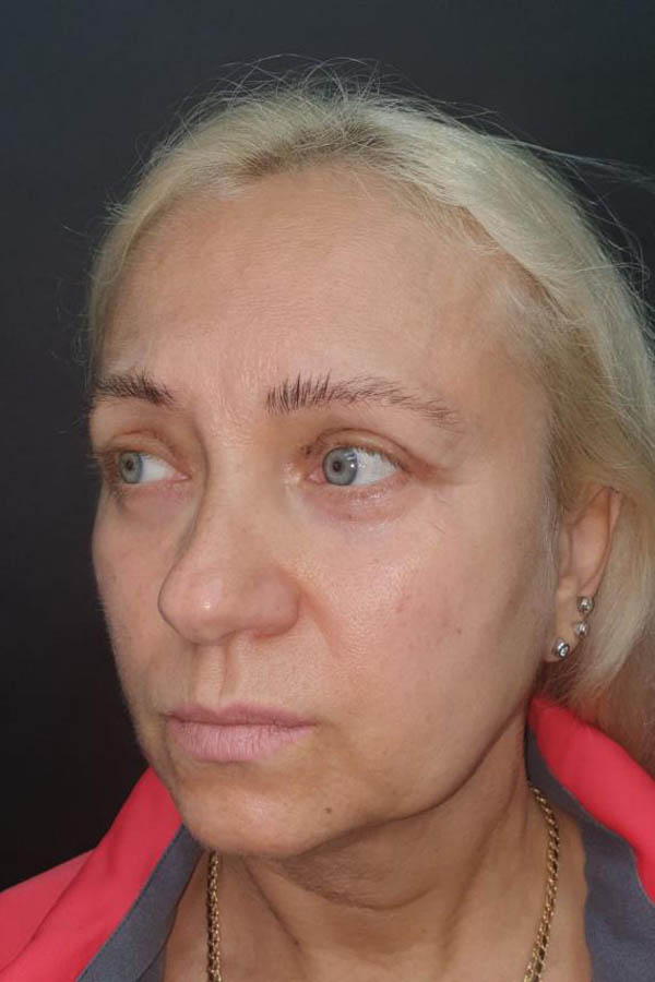 блефаропластика львів