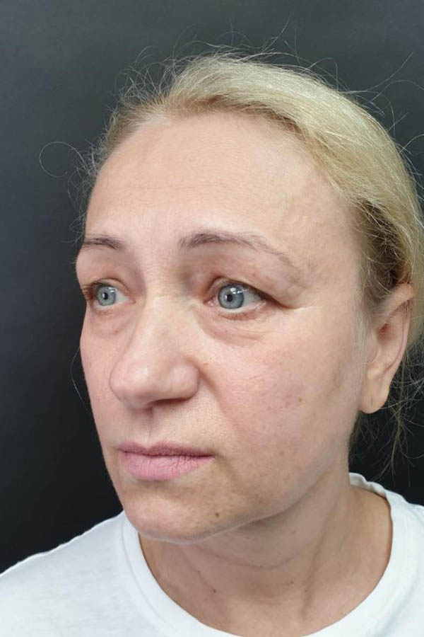 блефаропластика у львіві