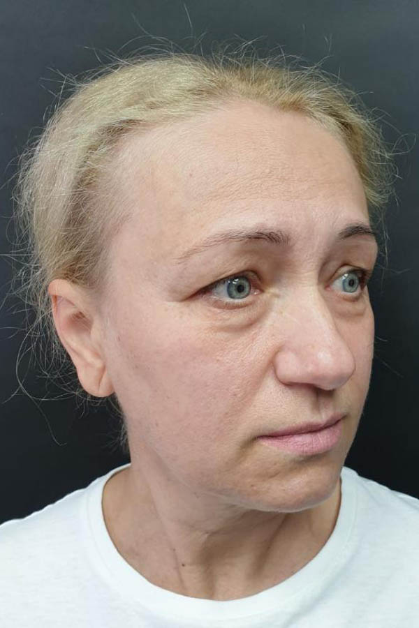 пластика повік у львові