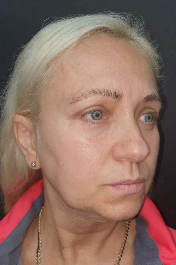 підтяжка повік львів